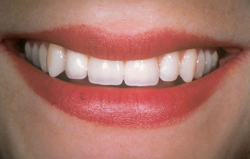 Dental-Implant-Thornhill Dentsit - After Dental-Implant-Thornhill Dentsit - After