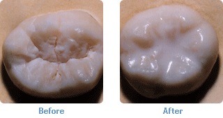 Dental Sealants - Thornhill Dentist - Procedural Diagram