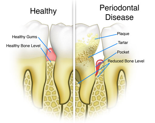 Periodontal Disease | Thornhill Family Dentist