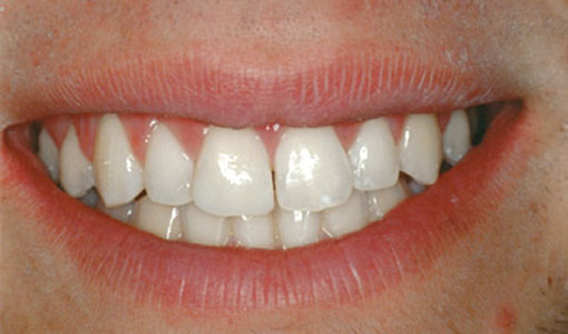 bonding-thronhill-dentist--after1 bonding-thronhill-dentist--after1