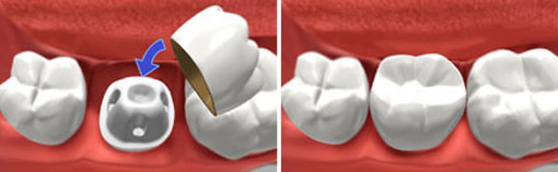 Crowns & Bridges Crowns & Bridges | Thornhill Family Dentistry
