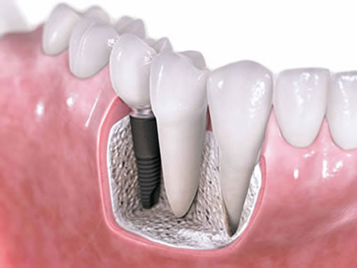 dental implants-thornhill dentist--illustration