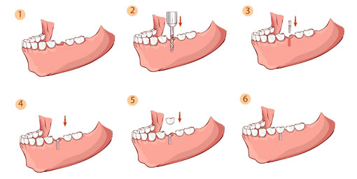 Procedural steps dental implants - thornhill dentist - Procedural steps
