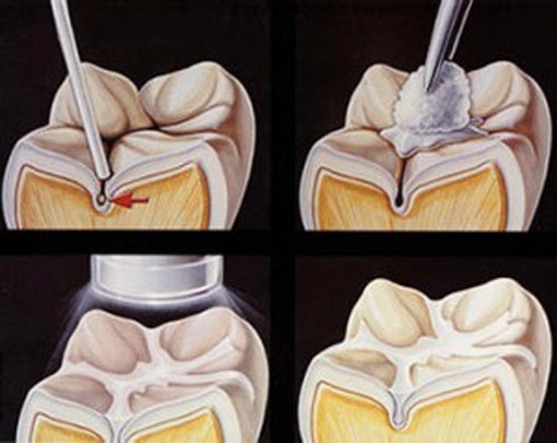 Dentist makes an X-ray Thornhill Dentist - Dentist makes Digital Dental X-rays