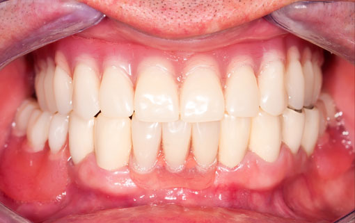dentures-after dentures-after