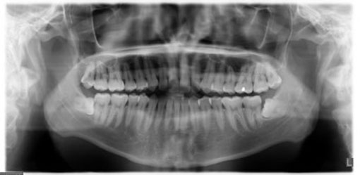 Digital X-Ray Digital X-ray | Thornhill Family Dentistry |Thornhill Dentist