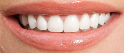 porcelain-veneers--thronhill-dentist--after