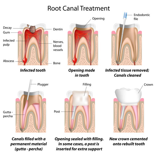 Stages of Treatment Root Canal Therapy - Thornhill Dentist - Stages of Treatment