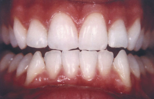 smile-makeovers-thornhill-dentist-after smile-makeovers-thornhill-dentist-after