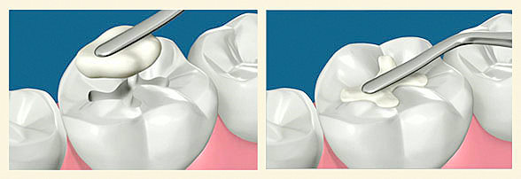 White Fillings - Application Thornhill Dentist-White Fillings - Application