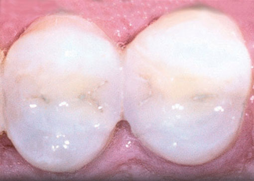 white-fillings - thornhill dentist -after