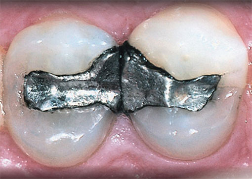 white-fillings - thornhill dentist - before