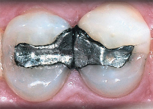 white-fillings - thornhill dentist - before white-fillings - thornhill dentist - before