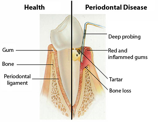 Periodontal Disease | Thornhill Family Dentist